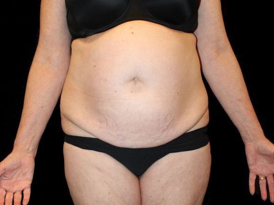 Tummy Tuck: Case 2 - Before