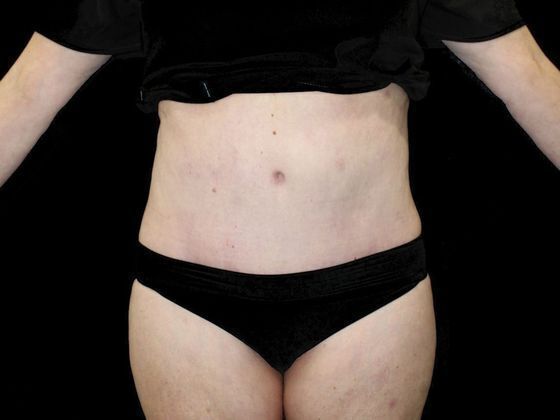 Tummy Tuck: Case 2 - After