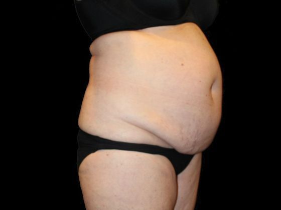 Tummy Tuck Case 2 - Before