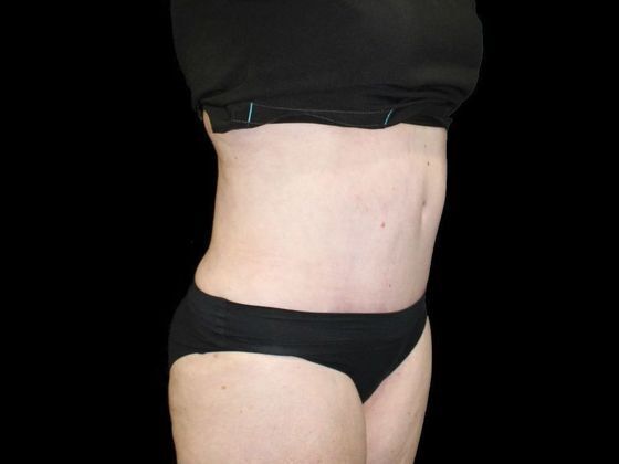 Tummy Tuck Case 2 - After