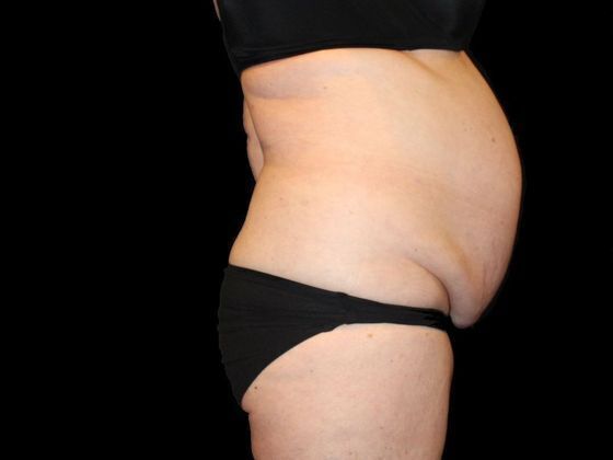 Tummy Tuck: Case 2 - Before