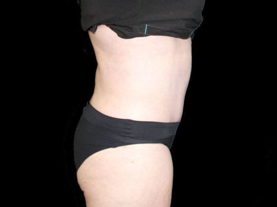 Tummy Tuck: Case 2 - After