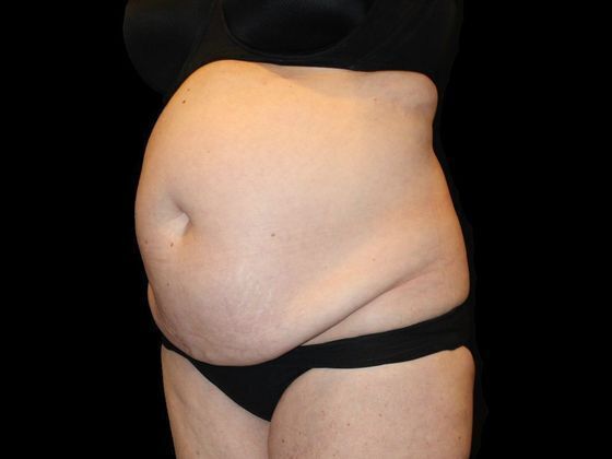 Tummy Tuck: Case 2 - Before