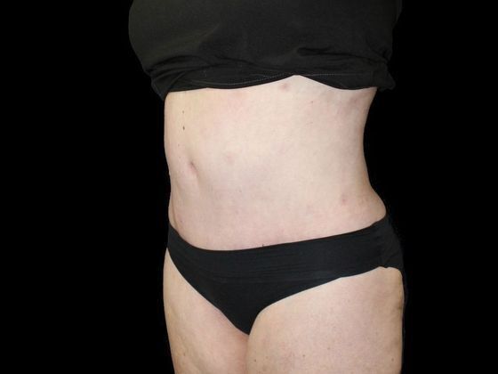 Tummy Tuck: Case 2 - After