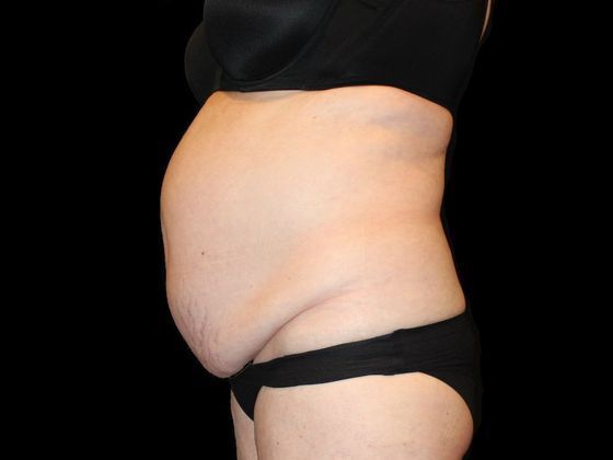 Tummy Tuck: Case 2 - Before