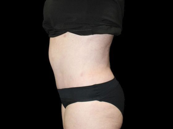 Tummy Tuck: Case 2 - After