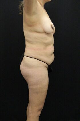 Tummy Tuck: Case 3 - Before
