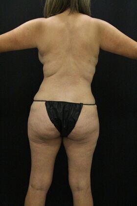 Tummy Tuck: Case 3 - After