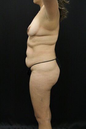 Tummy Tuck: Case 3 - Before