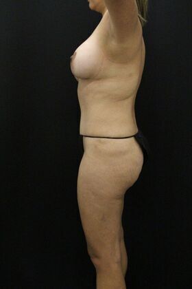 Tummy Tuck: Case 3 - After