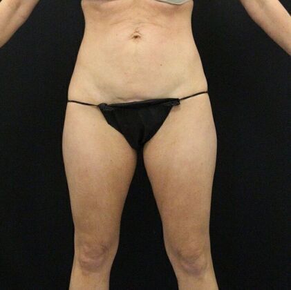 Tummy Tuck Case 4 - Before