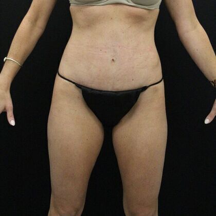 Tummy Tuck Case 4 - After