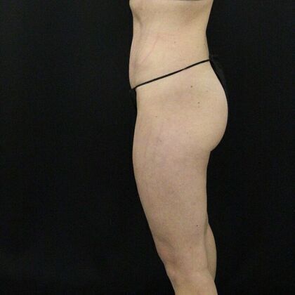 Tummy Tuck: Case 4 - After