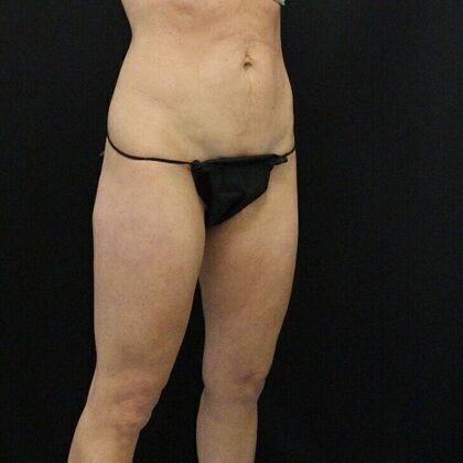 Tummy Tuck: Case 4 - Before