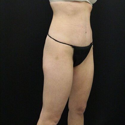 Tummy Tuck: Case 4 - After