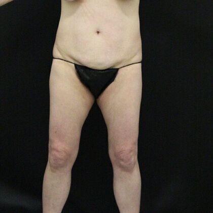 Tummy Tuck: Case 5 - Before