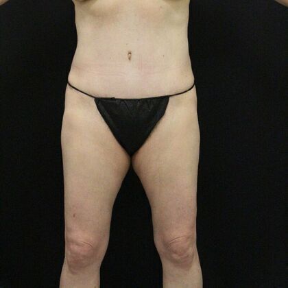 Tummy Tuck: Case 5 - After