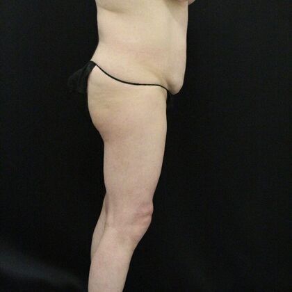 Tummy Tuck Case 5 - Before