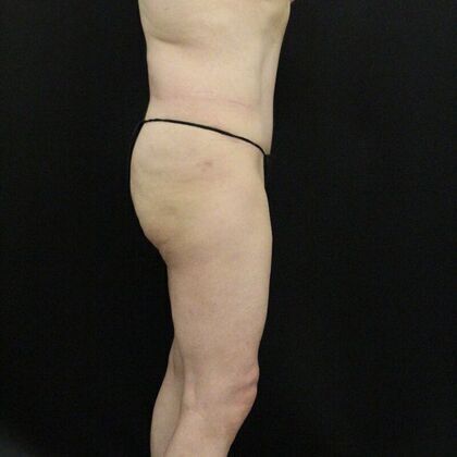 Tummy Tuck Case 5 - After