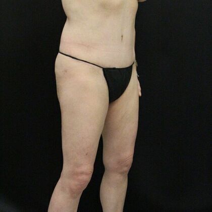 Tummy Tuck: Case 5 - After