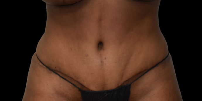 Abdominoplasty: Case 1 - After