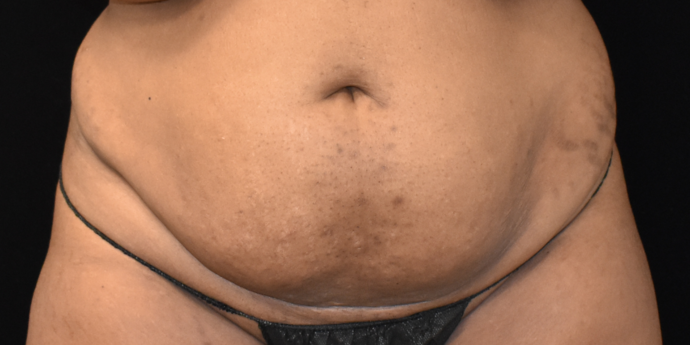 Abdominoplasty: Case 1 - Before