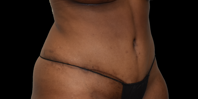 Abdominoplasty: Case 1 - After
