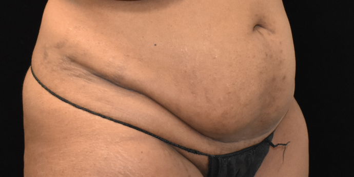 Abdominoplasty: Case 1 - Before
