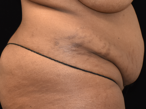 Abdominoplasty Case 1 - Before