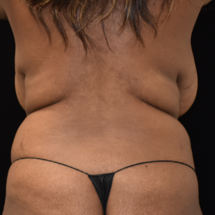 Abdominoplasty: Case 1 - Before