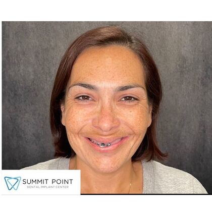 All on 4 Dental Implants Case 15 - Before