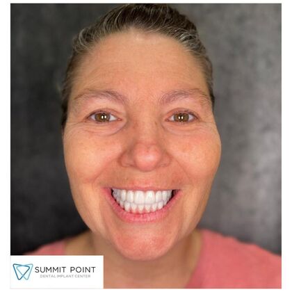 All on 4 Dental Implants Case 16 - After