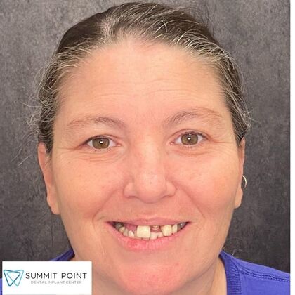 All on 4 Dental Implants Case 16 - Before