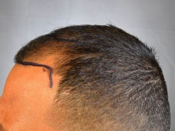 FUE Hair Restoration: Case 25 - Before