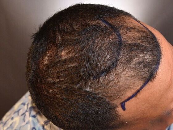 FUE Hair Restoration: Case 25 - Before