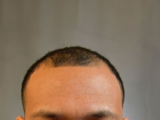 FUE Hair Restoration: Case 25 - Before