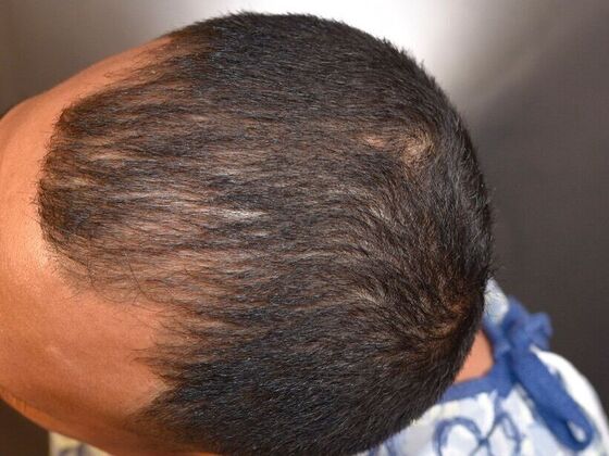 FUE Hair Restoration: Case 25 - Before
