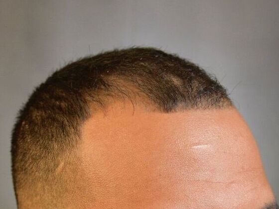 FUE Hair Restoration: Case 25 - Before