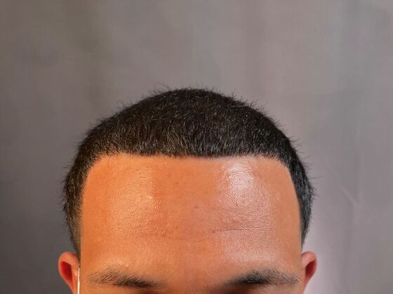 FUE Hair Restoration: Case 25 - After