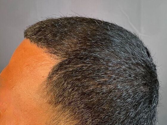FUE Hair Restoration: Case 25 - After