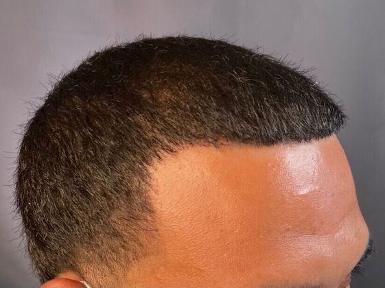 FUE Hair Restoration: Case 25 - After