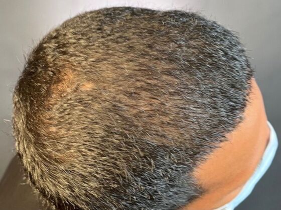 FUE Hair Restoration: Case 25 - After