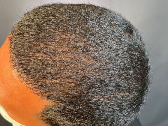 FUE Hair Restoration: Case 25 - After