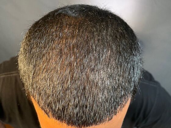 FUE Hair Restoration: Case 25 - After
