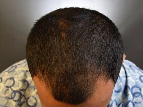 FUE Hair Restoration: Case 25 - Before