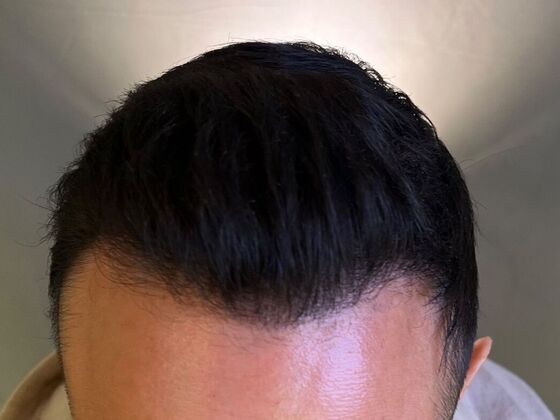FUE Hair Restoration: Case 26 - After