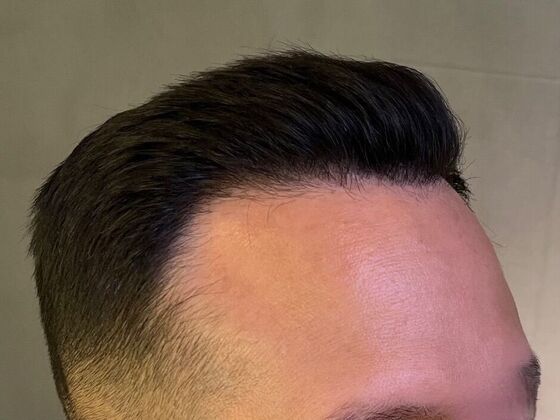 FUE Hair Restoration: Case 26 - After