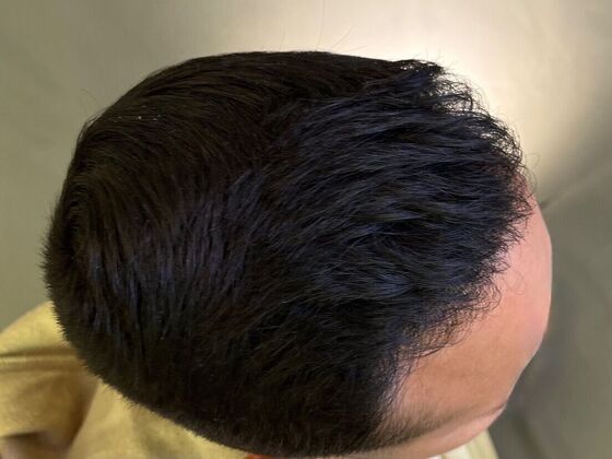 FUE Hair Restoration: Case 26 - After