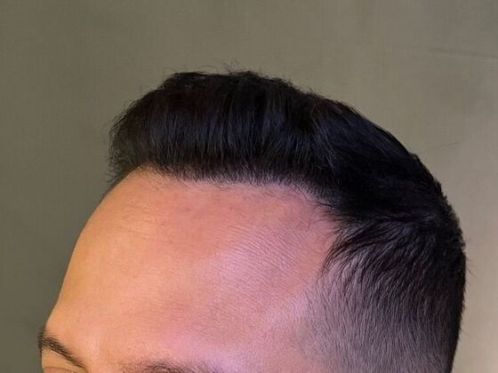 FUE Hair Restoration: Case 26 - After
