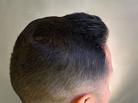 FUE Hair Restoration: Case 26 - After